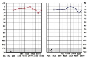 Pat's hearing chart.